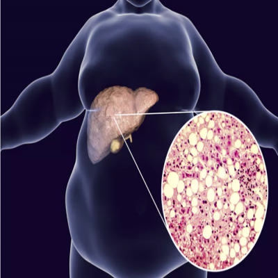 低碳饮食2周逆转脂肪肝，瑞典这个研究让脂肪肝患者都沸腾了