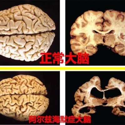 生酮饮食是否可以治疗阿尔兹海默病？